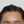 Forehead reduction (hairline lowering surgery) — after (14days) · Ria Plastic Surgery Clinic