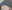 額縮小術（生え際下げ・ヘアライン下降術） — ザフィックス美容外科クリニック