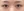 incisional double eyelid surgery — before (7days) · iLumi Plastic Surgery Clinic
