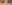裏ハムラ法（経結膜的眼窩脂肪移動術） — アーバン美容外科クリニック