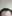 額縮小術（生え際下げ・ヘアライン下降術） — ザフィックス美容外科クリニック