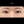 ผ่าตัดแก้ขนตาทิ่มตา (ขนตาแยงตา / เปลือกตาม้วนเข้า) — หลังทำ (20วัน) · รพ.ศัลยกรรมตกแต่งโอลโล