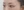 眼睑脂肪填充（上睑凹陷填充） — 术后 (10天) · 高唯医美诊所