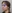 Bulbous nose correction (surgical nasal tip reduction) — Coco Line Clinic