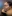 頬骨縮小術（全体／頬骨体部＋頬骨弓の骨切り） — サムサオ美容外科クリニック