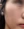 PRP skin rejuvenation (platelet-rich plasma therapy) — before (7days) · U&Me Clinic - Hongdae Branch
