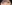 二重まぶた（自然癒着法） — プロミス美容外科クリニック