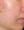 Superficial chemical peel (Korean 'skin scaling') — before (14days) · A-Top Plastic Surgery Clinic