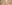 裏ハムラ法（経結膜的眼窩脂肪移動術） — プレジャー美容外科クリニック
