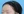 โบท็อกซ์หว่างคิ้ว — หลังทำ · คังนัมบีบีคลินิก