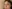 Lower Eyelid Fat Repositioning (transconjunctival) — Hershey Plastic Surgery Clinic