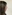 Bulbous nose correction (surgical nasal tip reduction) — Coco Line Clinic