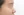 Paranasal (nasal base) augmentation with implant — before (14days) · iLumi Plastic Surgery Clinic