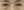 lower blepharoplasty (under-eye bag removal with fat repositioning) — before (7days) · Seoul During Clinic