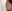 Short nose correction (nose lengthening / derotation) — Coco Line Clinic