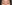 裏ハムラ法（経結膜的眼窩脂肪移動術） — プレジャー美容外科クリニック