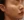 側臉頰填充（玻尿酸填補側臉頰凹陷） — 術後 · Cheongdam Dear 醫美診所