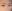 incisional double eyelid surgery — Brown Plastic Surgery