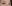 Brow lift — Marvel Plastic Surgery Clinic