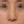 ผ่าตัดแก้ไขผนังกั้นช่องจมูกคด (Septoplasty) — หลังทำ (14วัน) · คลินิกโคบิจู
