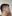 Double chin liposuction (submental liposuction) — Myong Plastic Surgery & Aesthetics