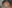 デュアルトーニング（2波長レーザートーニング） — ミケイ美容外科