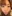 Full zygoma reduction (zygomatic body + arch osteotomy) — Uri Plastic Surgery Clinic