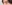 裏ハムラ法（経結膜的眼窩脂肪移動術） — ジャスト美容外科クリニック