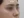 Nasal tip augmentation with implant — after (7days) · The Ollim Plastic Surgery Clinic