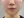 童颜针（舒颜萃/Sculptra）法令纹 — 术后 (30天) · Monster诊所
