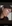 Bulbous nose correction (surgical nasal tip reduction) — DM Plastic Surgery Clinic