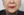 JUVGEN (autologous dermal regeneration / collagen-induction injection) — after (14days) · Saeroun Plastic Surgery