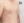 女性化乳房手術（男性の乳腺切除） — 術後 (15日) · ザ・美容外科