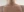 เลเซอร์สลายไขมันต้นขา — หลังทำ (60วัน) · คลินิกหมอซนยูนา