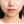 โบท็อกซ์ปีกจมูก — หลังทำ (14วัน) · คลินิก Only P