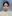 鼻尖形成術（自家軟骨移植） — ハイエンド美容外科クリニック
