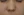 Non-incisional alar (nostril) reduction — suture/thread alar cinching — after (7days) · Wise U Clinic