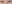 裏ハムラ法（経結膜的眼窩脂肪移動術） — ファクト美容外科クリニック