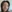 Nasal Tip Plasty with Autologous Cartilage — Zena Plastic Surgery