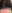 Hairline hair transplant (hairline lowering by grafting) — MoPro Clinic