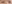 Ptosis Correction (levator surgery / eye-shape correction) — iNique Plastic Surgery & Aesthetics
