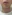 Beard laser hair removal — Mio Clinic