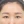 内視鏡下眉毛挙上術（内視鏡ブローリフト） — 術後 (14日) · エイビー美容外科クリニック