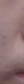 acne scar subcision / regenerative needling — after (42days) · Haneulche Korean Medicine Clinic - Daejeon Branch