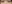 裏ハムラ法（経結膜的眼窩脂肪移動術） — シンサエル美容外科