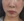 Botox for nasolabial folds — before (10days) · VS Line Clinic - Incheon Guwol Branch