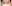 裏ハムラ法（経結膜的眼窩脂肪移動術） — ルアク美容外科クリニック