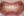 Metal bracket braces (traditional fixed orthodontics) — after (122days) · Yeonse Bareun Dental Clinic