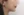 ตัดไขมันกระพุ้งแก้ม — หลังทำ (9วัน) · ไอรูมิ ศัลยกรรมพลาสติก