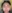 二重あごの脂肪吸引（顎下脂肪吸引） — ソウル童顔クリニック